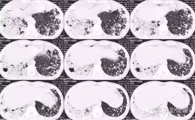 【病例】弥漫性肺泡细胞癌1例CT影像表现