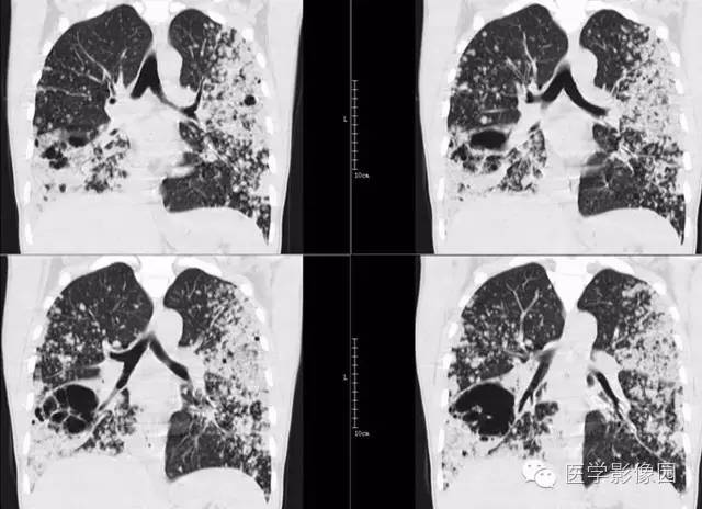 【病例】弥漫性肺泡细胞癌1例CT影像表现