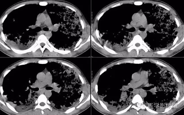 【病例】弥漫性肺泡细胞癌1例CT影像表现