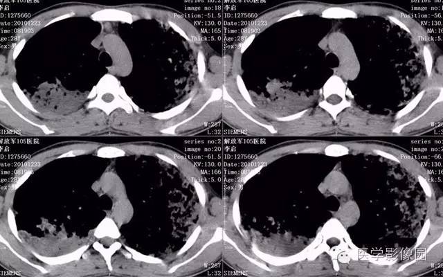 【病例】弥漫性肺泡细胞癌1例CT影像表现