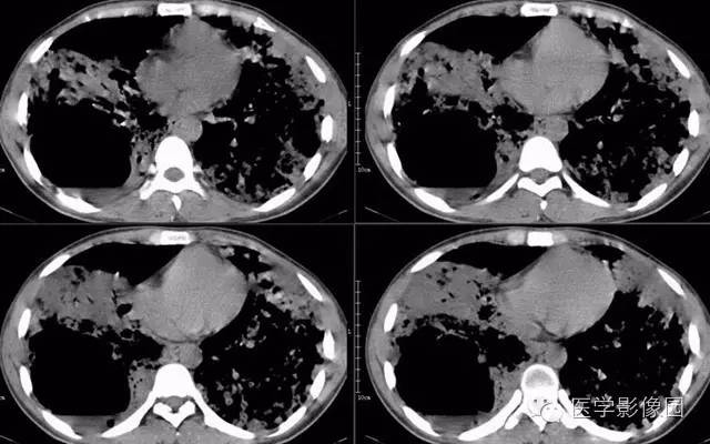 【病例】弥漫性肺泡细胞癌1例CT影像表现