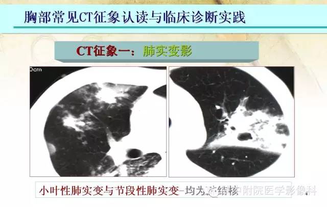 【PPT】胸部常见疾病的CT基本征象
