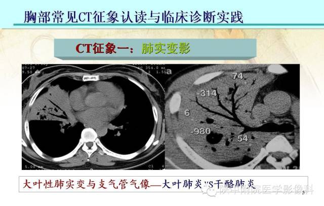 【PPT】胸部常见疾病的CT基本征象