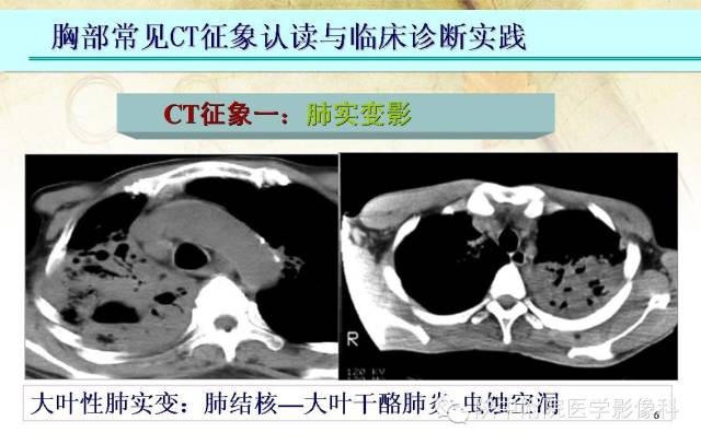 【PPT】胸部常见疾病的CT基本征象