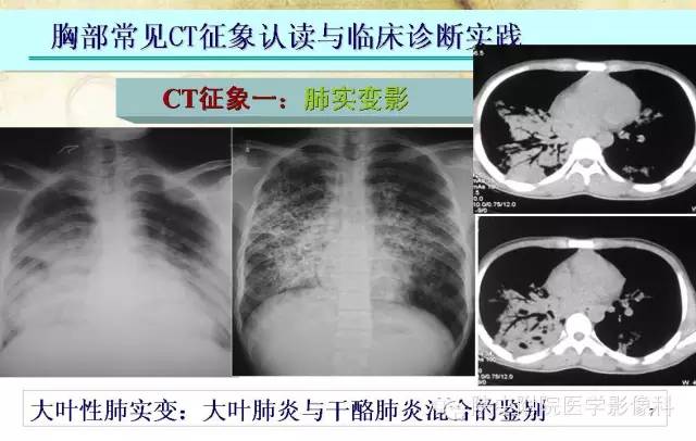 【PPT】胸部常见疾病的CT基本征象