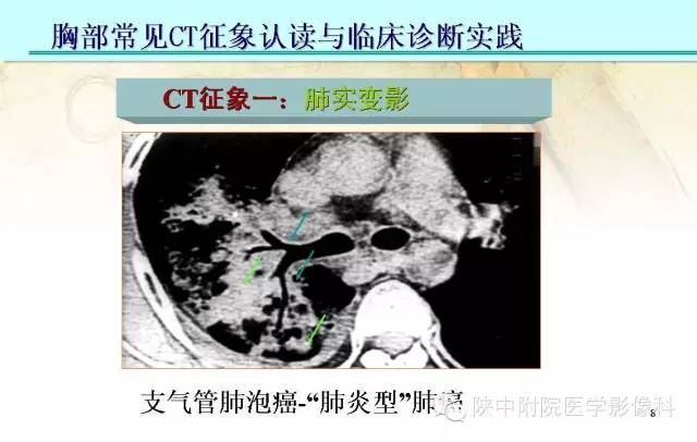 【PPT】胸部常见疾病的CT基本征象