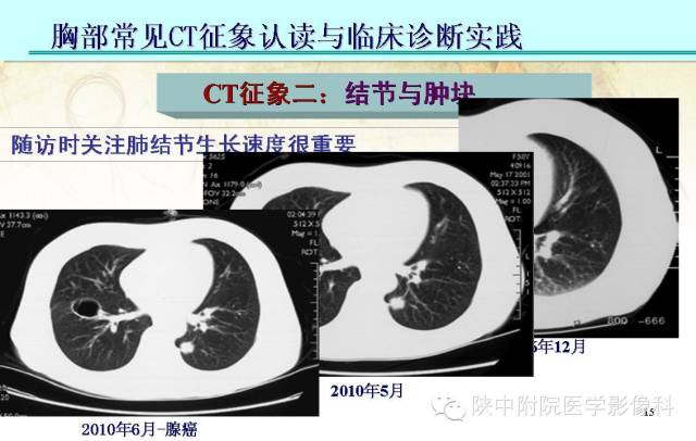 【PPT】胸部常见疾病的CT基本征象