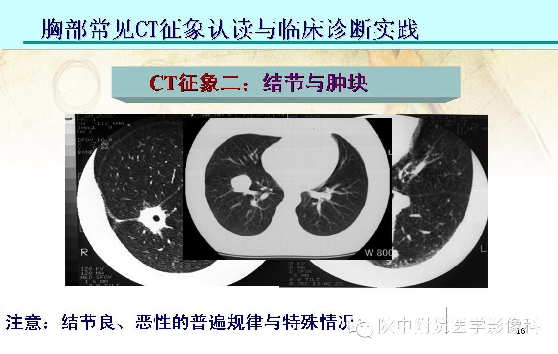 【PPT】胸部常见疾病的CT基本征象