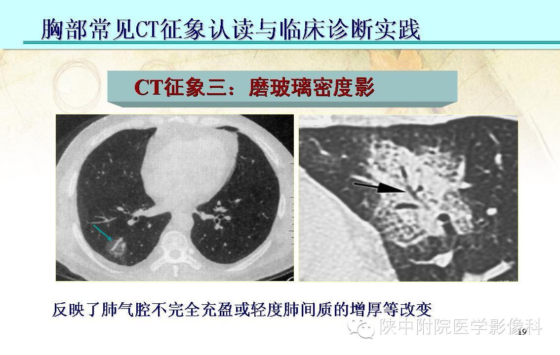 【PPT】胸部常见疾病的CT基本征象