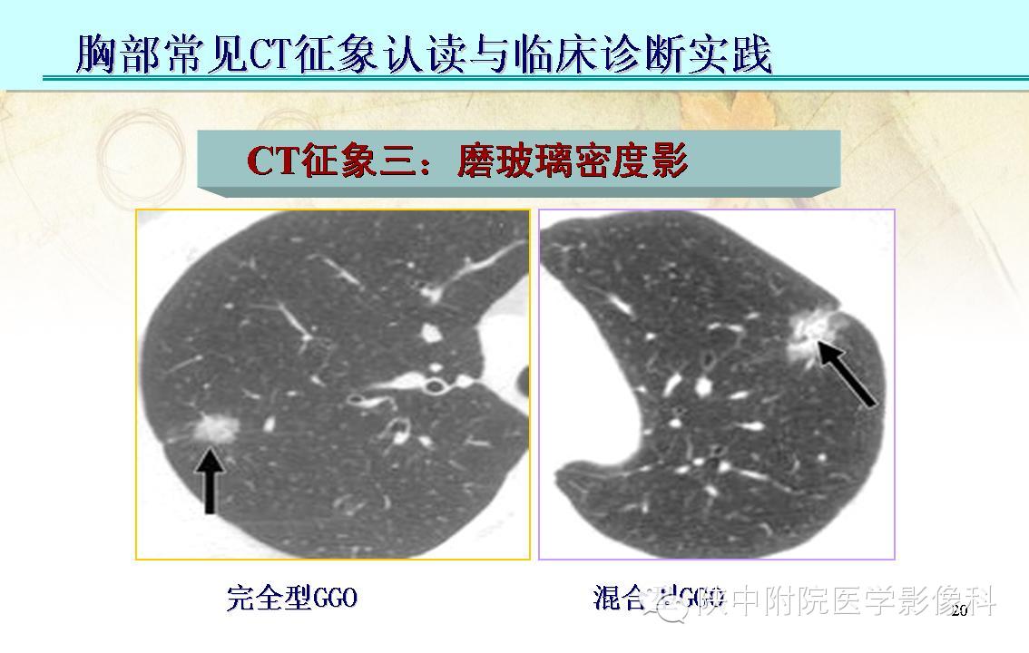【PPT】胸部常见疾病的CT基本征象