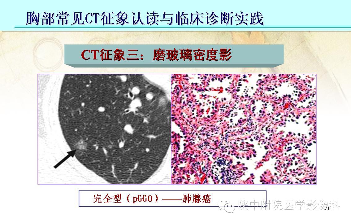 【PPT】胸部常见疾病的CT基本征象