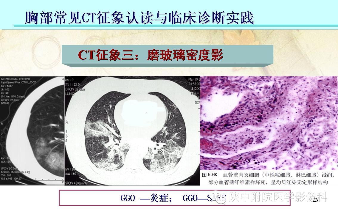 【PPT】胸部常见疾病的CT基本征象