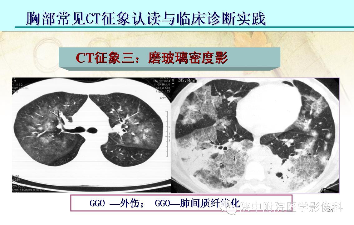【PPT】胸部常见疾病的CT基本征象