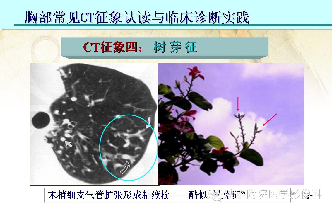 【PPT】胸部常见疾病的CT基本征象