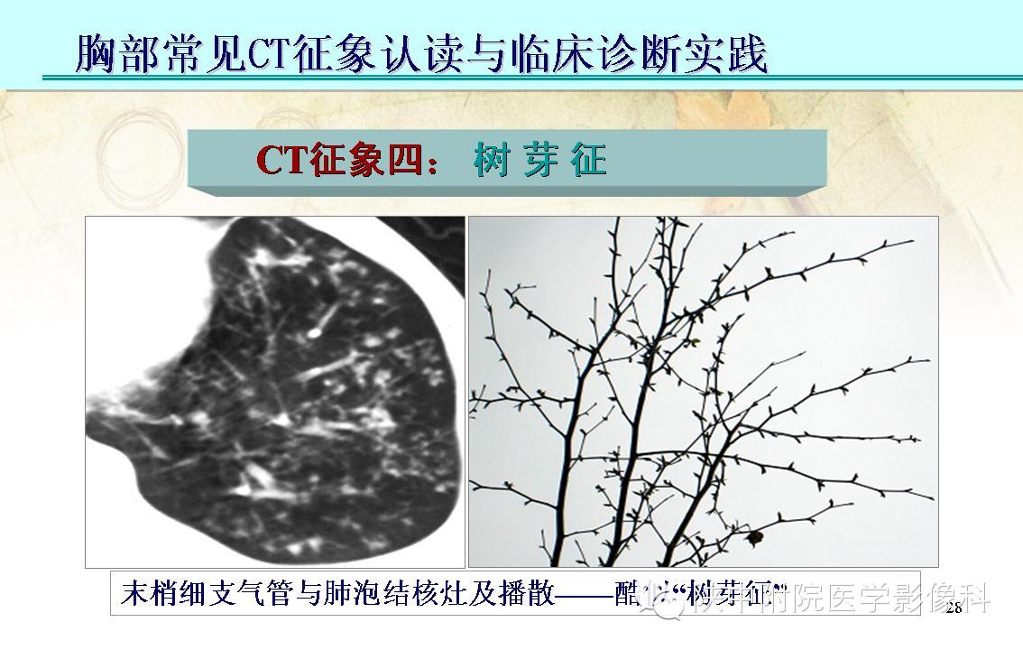 【PPT】胸部常见疾病的CT基本征象