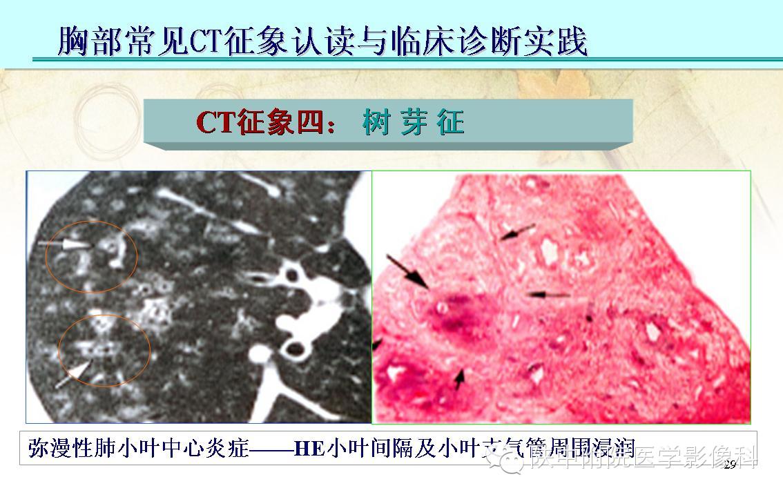 【PPT】胸部常见疾病的CT基本征象