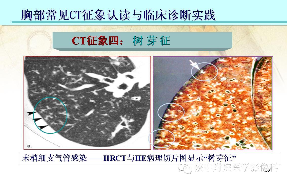 【PPT】胸部常见疾病的CT基本征象