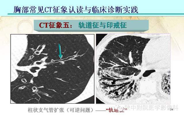 【PPT】胸部常见疾病的CT基本征象
