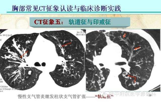 【PPT】胸部常见疾病的CT基本征象