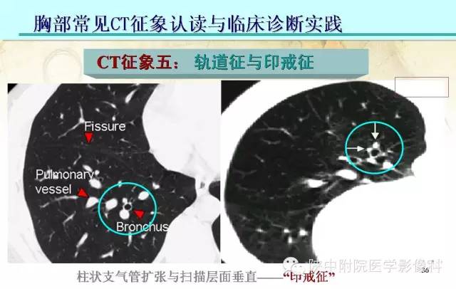 【PPT】胸部常见疾病的CT基本征象