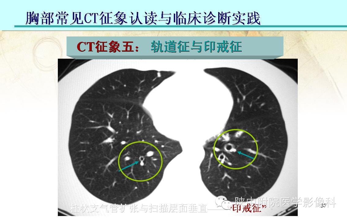 【PPT】胸部常见疾病的CT基本征象