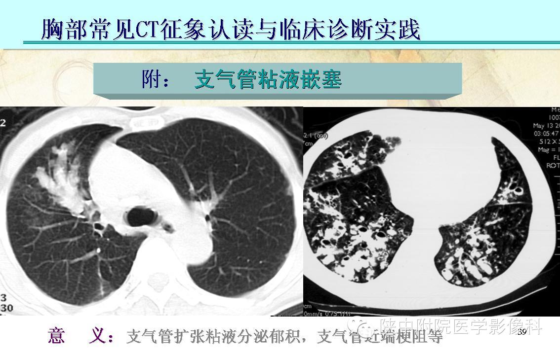 【PPT】胸部常见疾病的CT基本征象