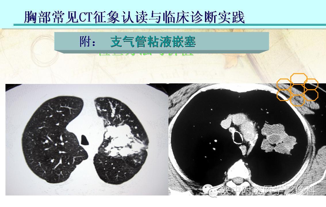 【PPT】胸部常见疾病的CT基本征象