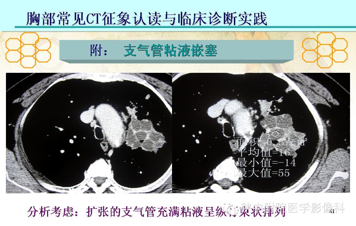 【PPT】胸部常见疾病的CT基本征象