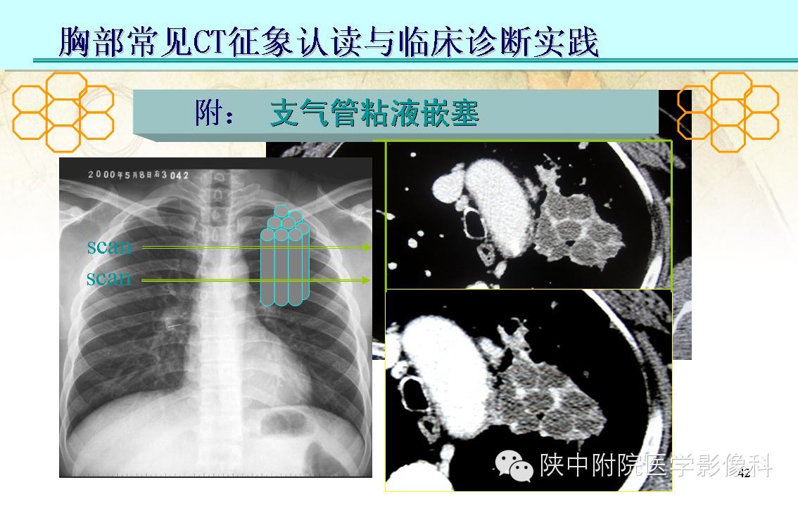 【PPT】胸部常见疾病的CT基本征象