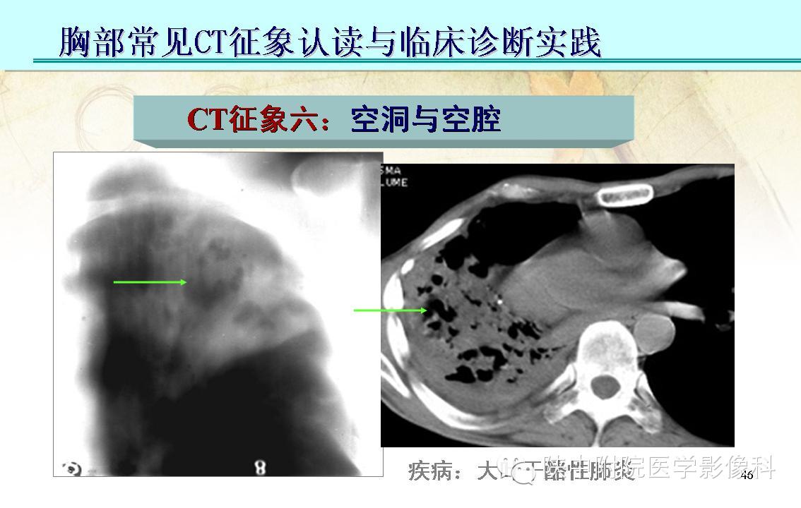 【PPT】胸部常见疾病的CT基本征象