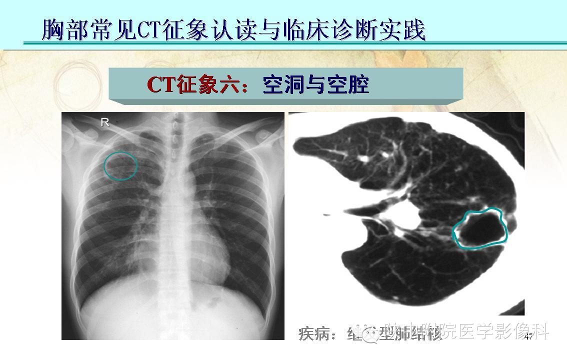 【PPT】胸部常见疾病的CT基本征象