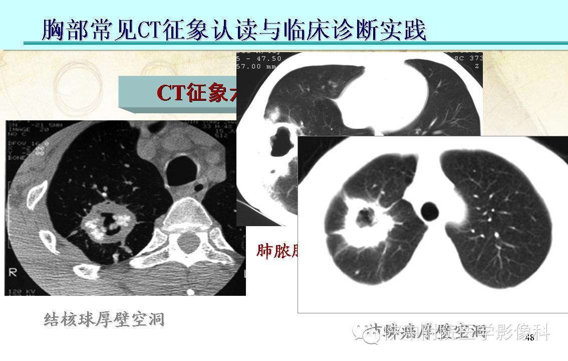 【PPT】胸部常见疾病的CT基本征象