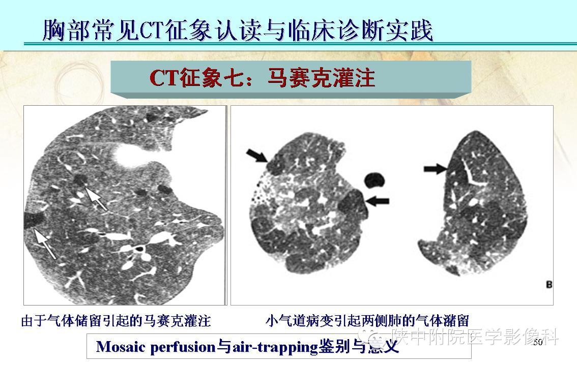 【PPT】胸部常见疾病的CT基本征象