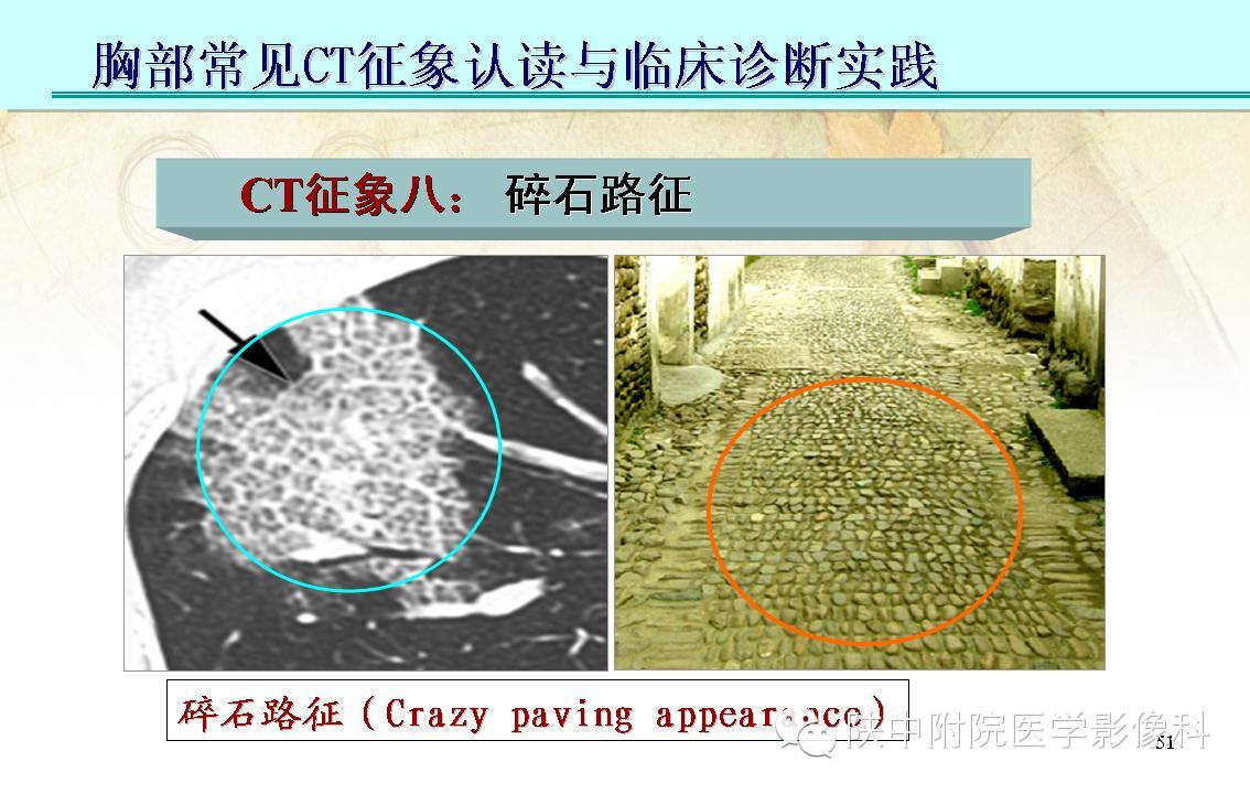 【PPT】胸部常见疾病的CT基本征象