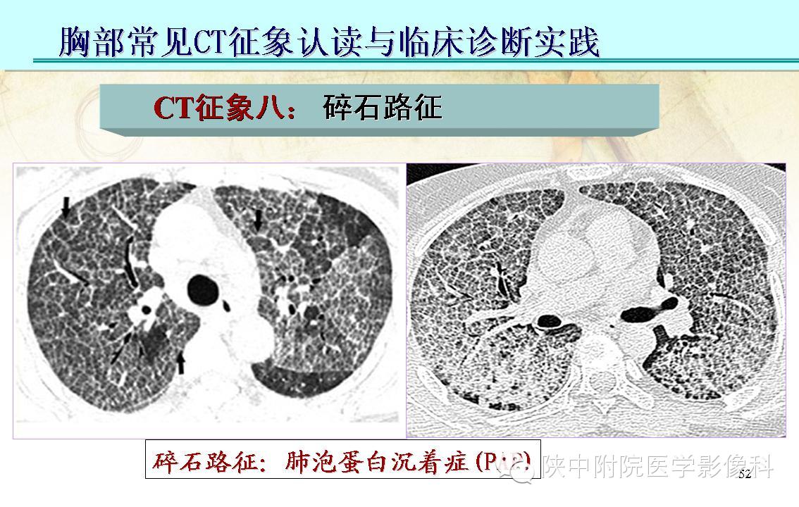 【PPT】胸部常见疾病的CT基本征象
