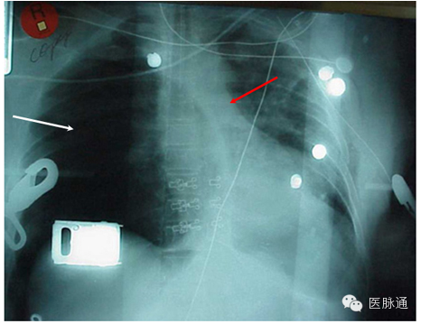 不容忽视的X线诊断要点