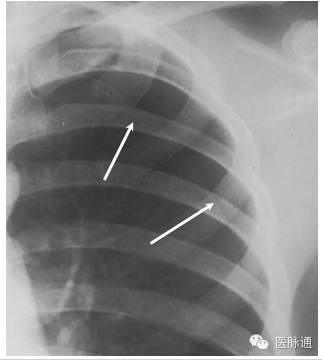 不容忽视的X线诊断要点