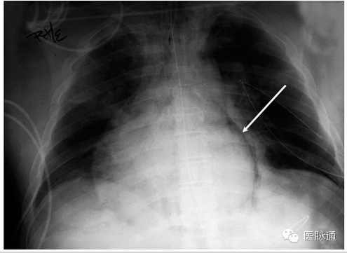 不容忽视的X线诊断要点