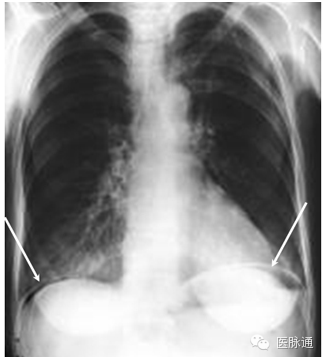 不容忽视的X线诊断要点