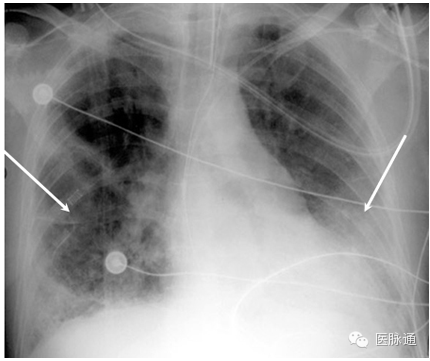 不容忽视的X线诊断要点