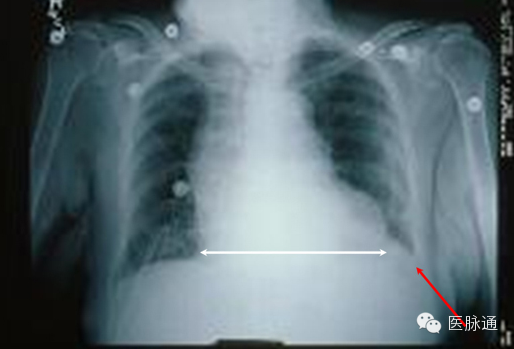 不容忽视的X线诊断要点