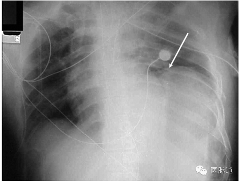 不容忽视的X线诊断要点