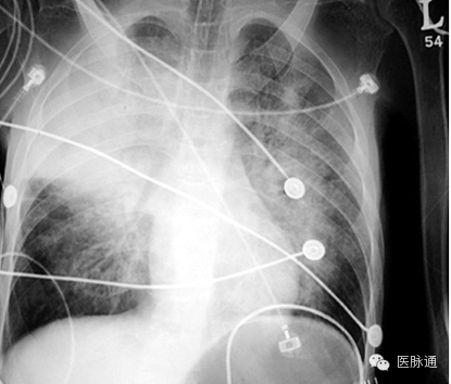 不容忽视的X线诊断要点