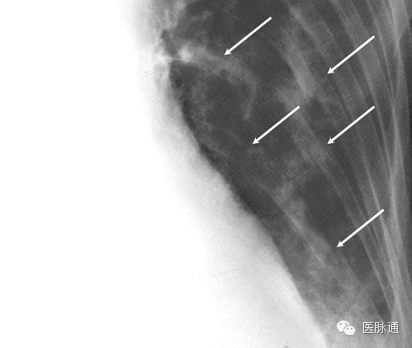 不容忽视的X线诊断要点