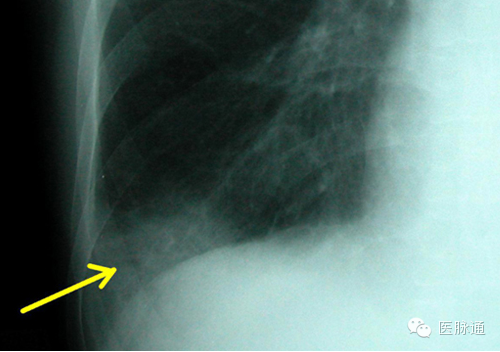 不容忽视的X线诊断要点