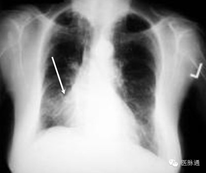 不容忽视的X线诊断要点