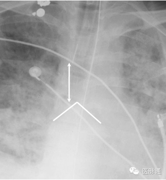 不容忽视的X线诊断要点