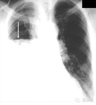不容忽视的X线诊断要点