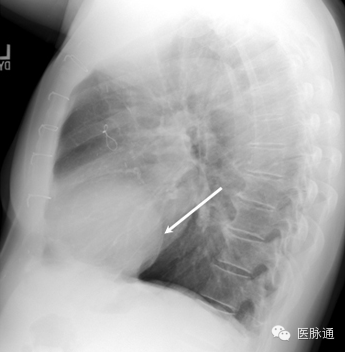 不容忽视的X线诊断要点