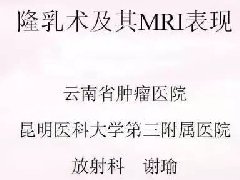 隆乳术及其MRI表现